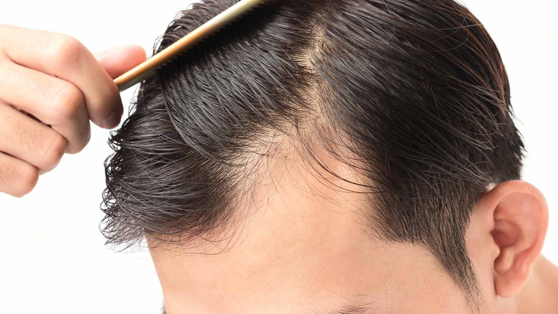 7 natural remedies & treatments to stop hair loss & thinning