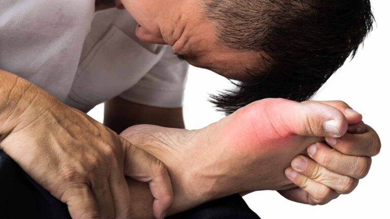 gout pain toe arthritis inflammation natural remedies